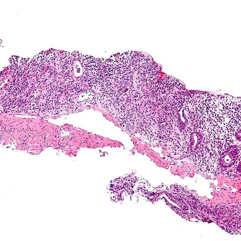 Enterovirus D68 electron micrograph